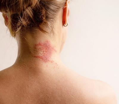 Dermatitis na lasišču: znaki, vzroki in zdravljenje (kako ga ločiš od prhljaja)