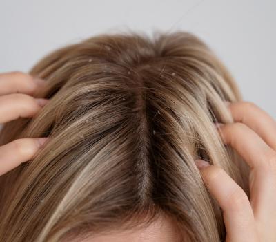Glivice na koži: prhljaj, dermatitis in druge težave 